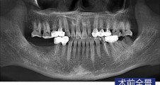 數字化(huà)導闆 下(xià)颌磨牙常規種植病例2