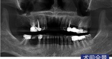 磨牙常規種植病例