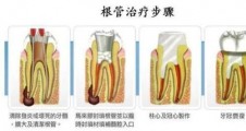 【奧泰診療中心】為(wèi)什麽根管治療需要多次就診？