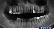 數字化(huà)導闆 下(xià)颌磨牙常規種植病例