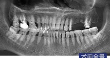 數字化(huà)導闆 前磨牙磨牙微(wēi)創種植病例