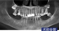 下(xià)颌磨牙常規種植 磨牙拔除清創 智齒拔除病例