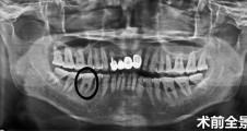 磨牙區(qū)即拔即種病例