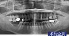 磨牙即拔即種常規種植最終修複病例