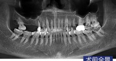 上(shàng)颌窦內(nèi)提升術磨牙微(wēi)創種植病例