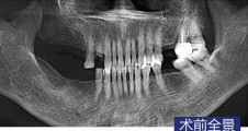 數字化(huà)導闆微(wēi)創種植 磨牙即拔即種+常規種植 智齒拔除病例