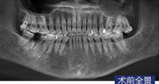 單顆磨牙即拔即種病例