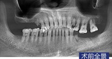 數字化(huà)導闆微(wēi)創種植 上(shàng)颌窦內(nèi)提升術+GBR術 前磨牙磨牙即拔即種病例