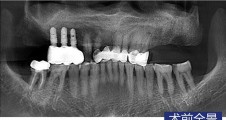 磨牙微(wēi)創常規種植病例2