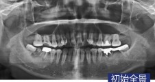 不良修複體(tǐ)拆除 磨牙常規種植 智齒拔除病例