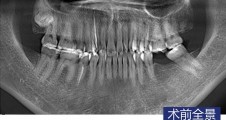 單顆磨牙常規種植病例
