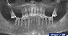 前磨牙即拔即種 磨牙常規種植病例