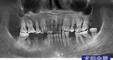 前磨牙磨牙常規種植 智齒拔除病例