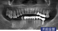 數字化(huà)導闆 磨牙即拔即種 磨牙微(wēi)創種植病例