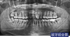 磨牙拔除後延期種植 上(shàng)颌窦外(wài)提升術 GBR術種植病例