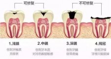 【奧泰診療中心】根管治療後為(wèi)什麽要做牙冠？其實主要基于這(zhè)3個(gè)原因！