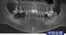 磨牙即拔即種+GBR術 常規種植 智齒拔除病例