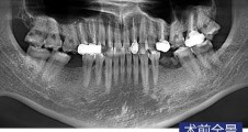 磨牙常規種植病例 (2)