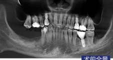 數字化(huà)導闆種植 磨牙常規種植病例