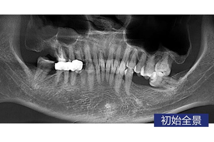 智齒拔除常規牙齒種植