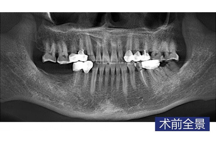 數字化(huà)導闆 下(xià)颌磨牙常規種植病例2