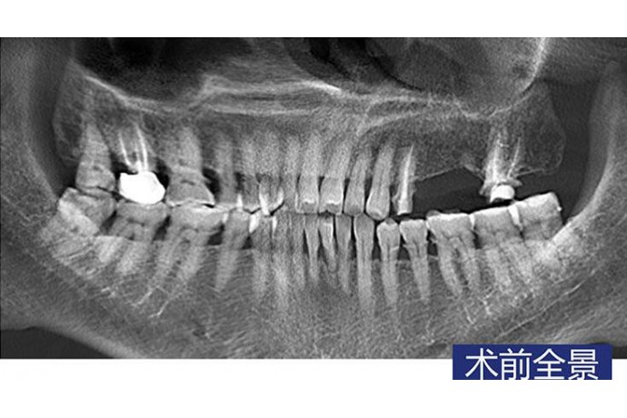 數字化(huà)導闆 前磨牙微(wēi)創種植病例
