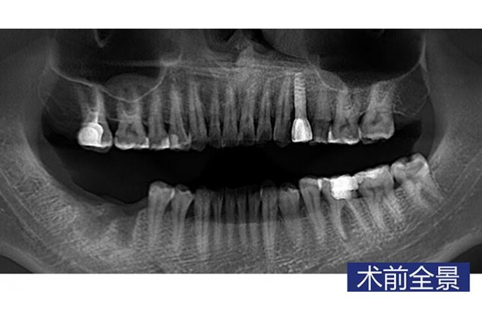 數字化(huà)導闆 下(xià)颌磨牙常規種植病例