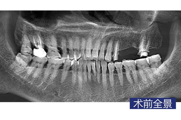 數字化(huà)導闆 前磨牙磨牙微(wēi)創種植病例