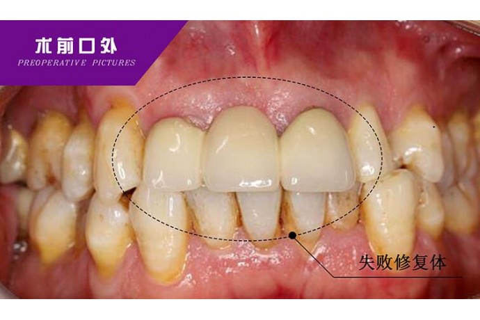 失敗烤瓷橋體(tǐ)再修複