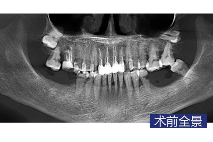 下(xià)颌磨牙常規種植 磨牙拔除清創 智齒拔除病例