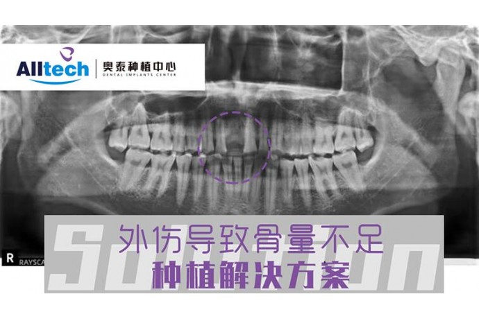 外(wài)傷導緻骨量不足 種植解決方案