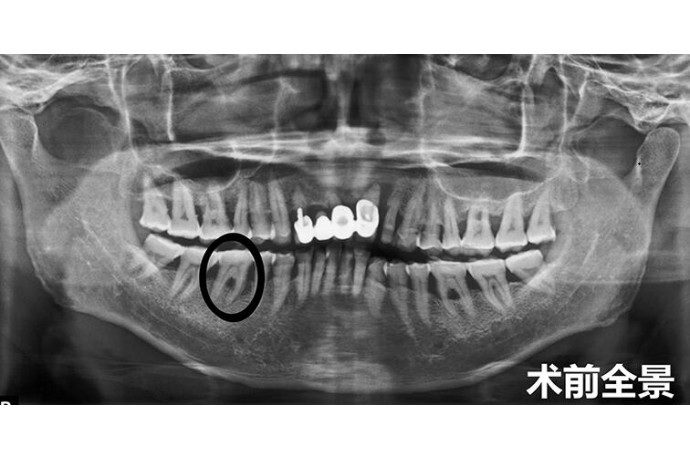 磨牙區(qū)即拔即種病例