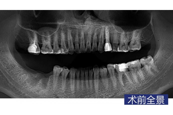 數字化(huà)導闆磨牙即拔即種常規種植病例