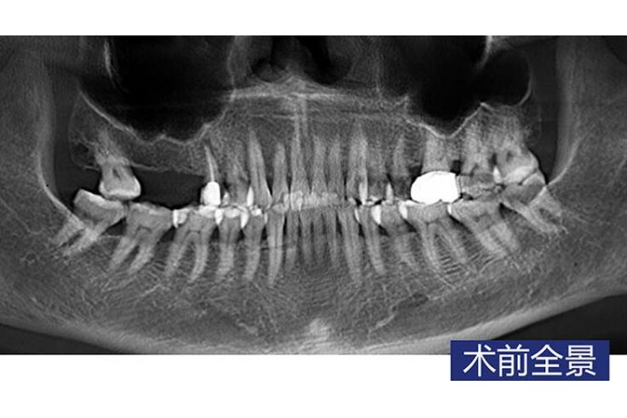 上(shàng)颌窦內(nèi)提升術磨牙微(wēi)創種植病例