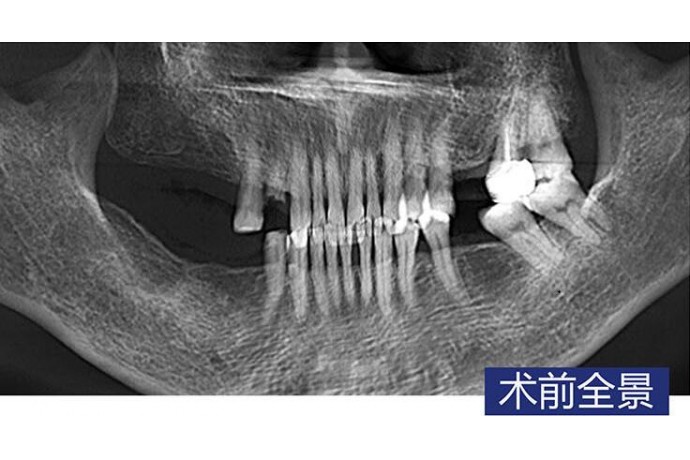 數字化(huà)導闆微(wēi)創種植 磨牙即拔即種+常規種植 智齒拔除病例