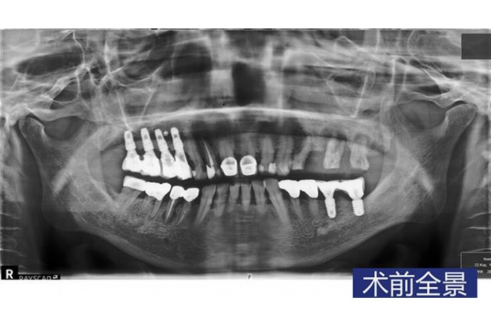 數字化(huà)導闆種植 前磨牙磨牙微(wēi)創種植病例