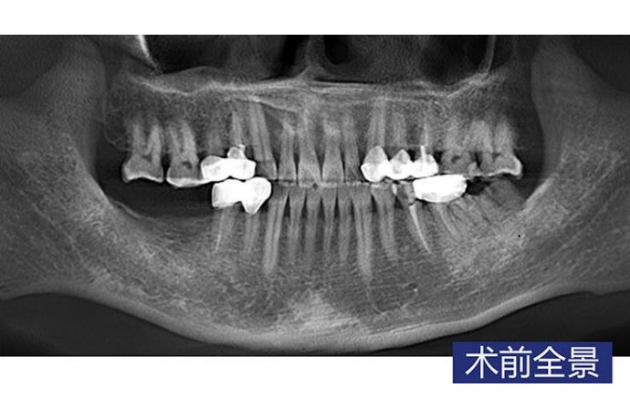 數字化(huà)導闆 磨牙即拔即種常規種植病例