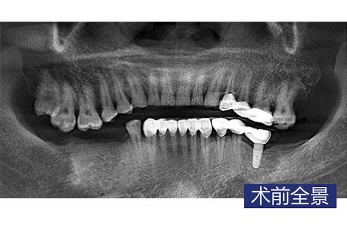 數字化(huà)導闆 磨牙即拔即種 磨牙微(wēi)創種植病例