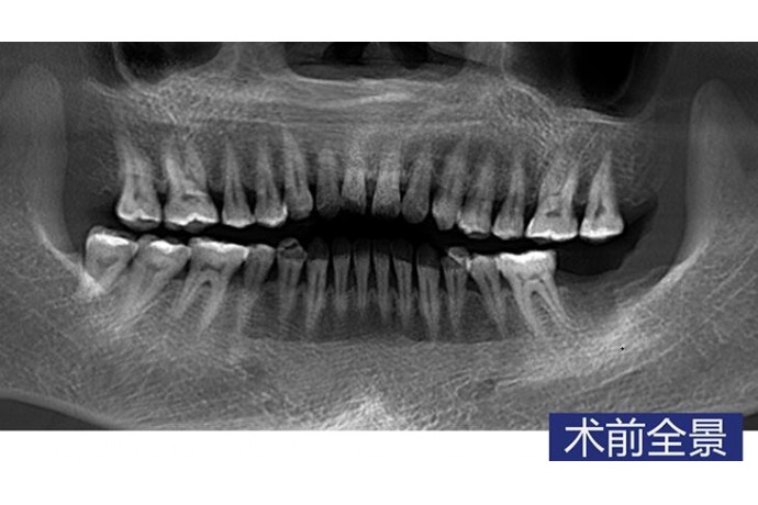 數字化(huà)導闆 單顆磨牙微(wēi)創種植病例