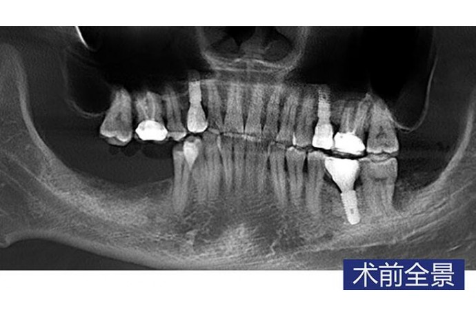 數字化(huà)導闆種植 磨牙常規種植病例