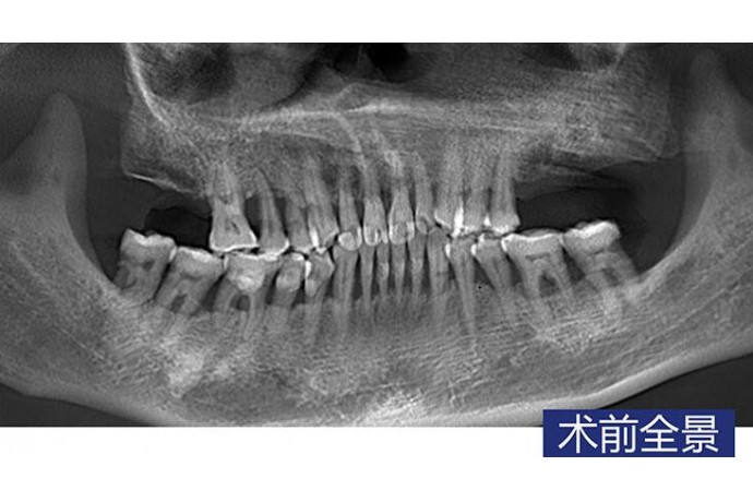 數字化(huà)導闆 磨牙常規+微(wēi)創種植病例