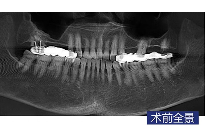 上(shàng)颌窦內(nèi)提升術 智齒拔除 前磨牙磨牙種植病例