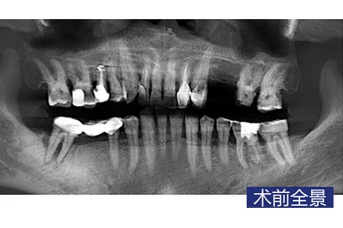 數字化(huà)導闆 前磨牙常規種植病例